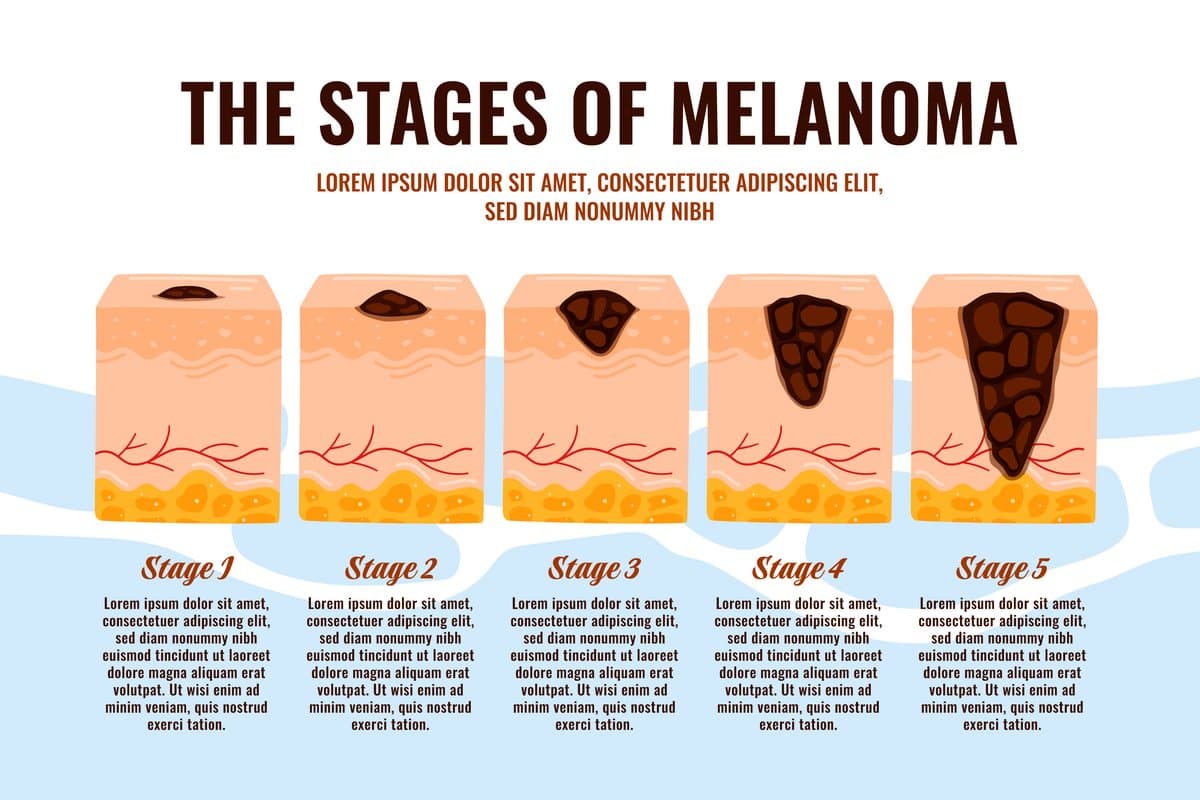 Types of Acne: From Blackheads to Cystic Nightmares