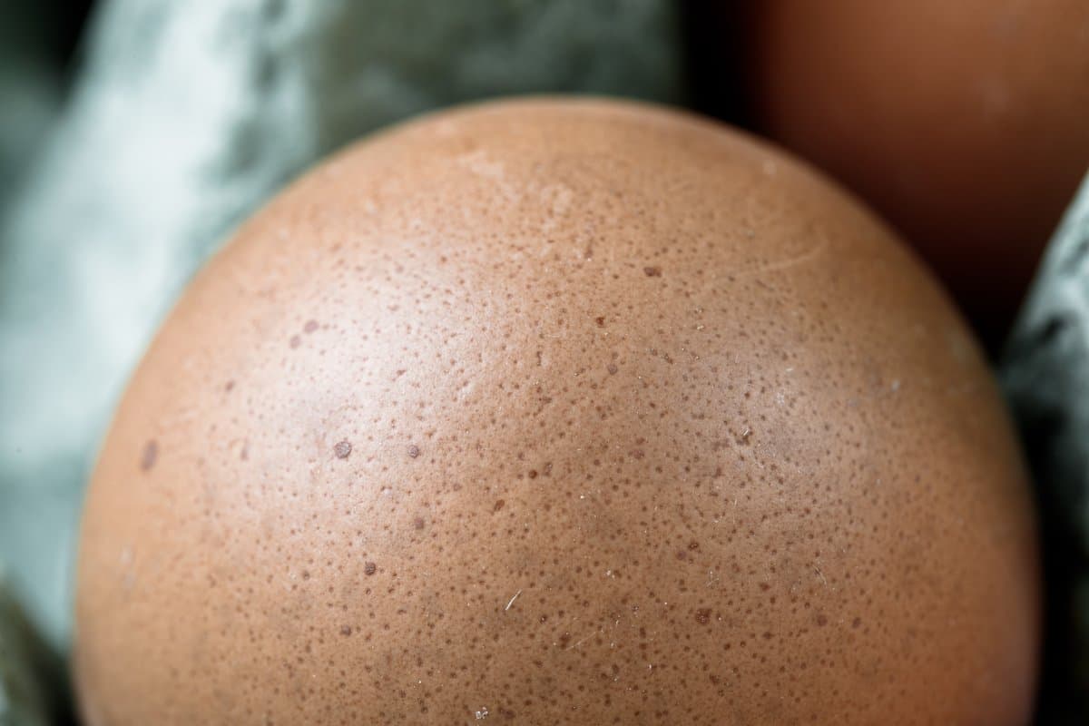 What Is a Dysplastic Nevus?