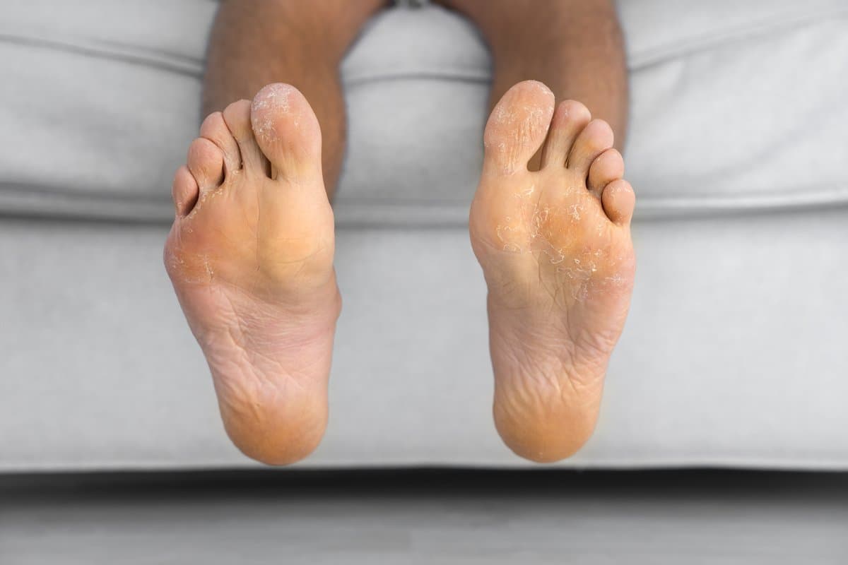 What Is Tinea Pedis?