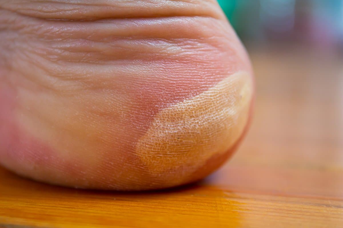 Types of Athlete's Foot